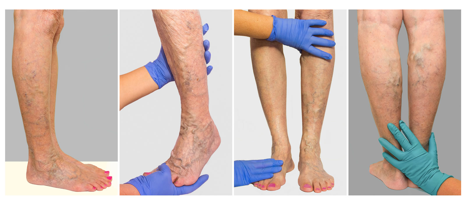 Vier Bilder von Beinen mit Krampfadern, die von behandschuhten Händen untersucht werden.
